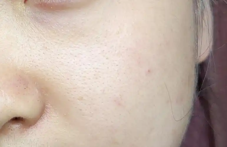 求助!干皮夏天额头出油,毛孔粗大怎么整