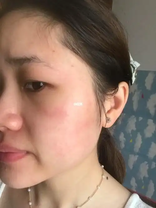 脂皮换季期的皮肤状态