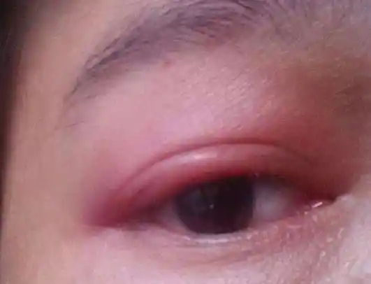 眼睑水肿从肾上找原因__凤凰网