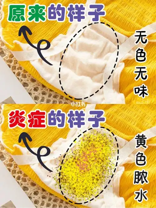 看白带分辨妇科炎症,女生你别大意93 很早的时候检查出来的妇科炎症