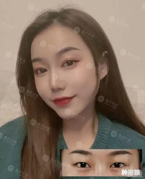 不适合做双眼皮的人,"我偏要勉强"的后果是