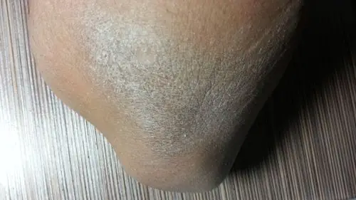 应该怎么治疗?以前用维a酸乳膏