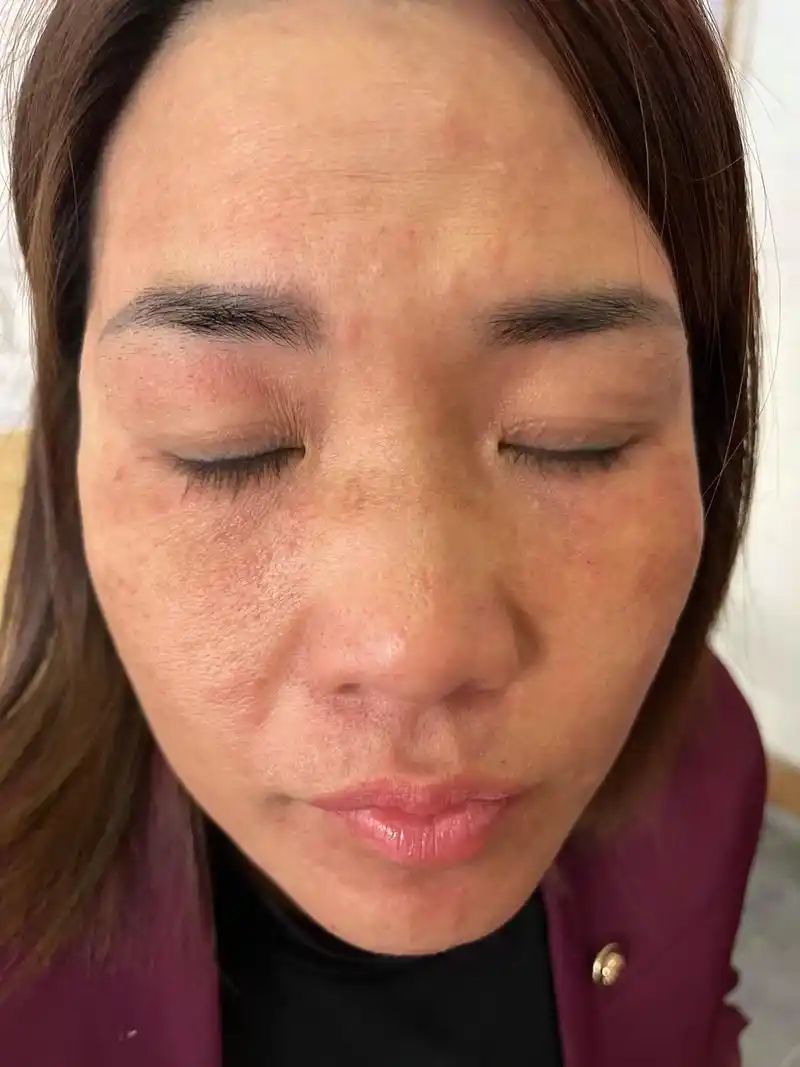 这是我的姐妹,3月11日那天见她脸过敏痒得难受,我就用能量板 - 抖音