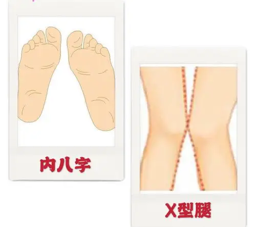 方法:怎么改善内八字或x形腿       有内八字的孩子,家长应鼓励其 游