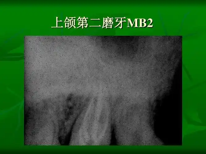 《口腔内科学》 上颌第二磨牙mb2