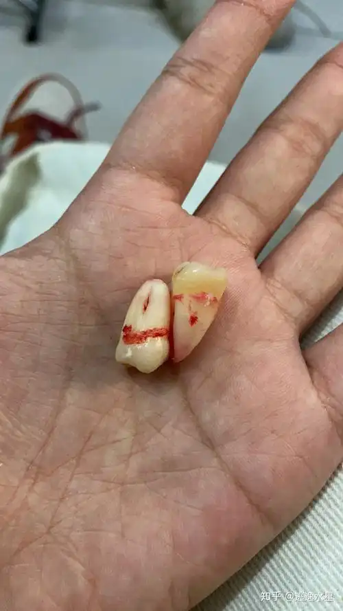 智齿长得很好(即正位不痛)是什么体验?