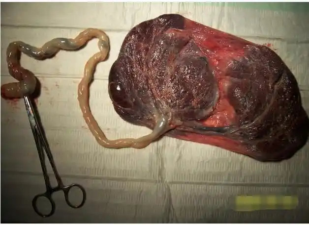 2005年3月,原卫生部公布《关于产妇分娩后胎盘处理问题的批复》,明确