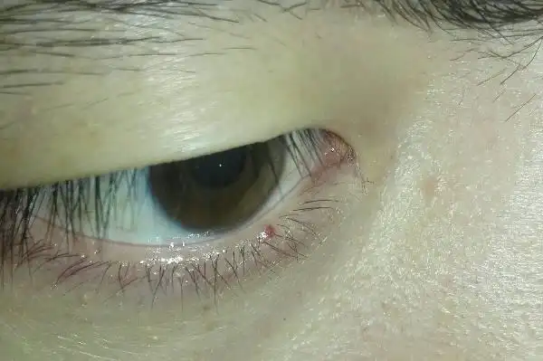 各位大侠,请帮我看下我的右边眼睛下面有个红点,是前天(5.28)刚长