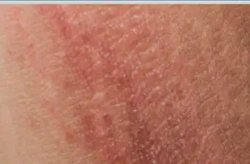 大腿根内侧红肿 走路摩擦就痛