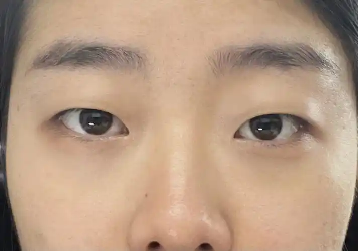 双眼皮or单眼皮