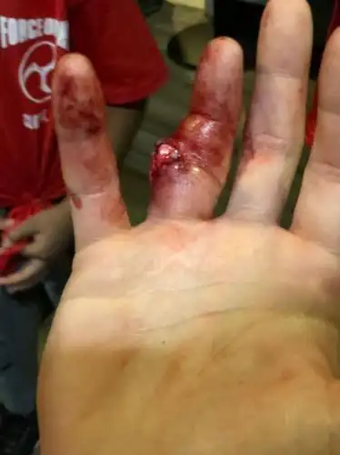 创造格斗奇迹美国mma格斗硬汉手指断成两截依然击败对手