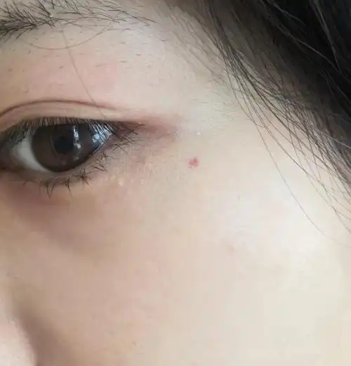 朱砂痣真实长相图片,脸上朱砂痣真实图片