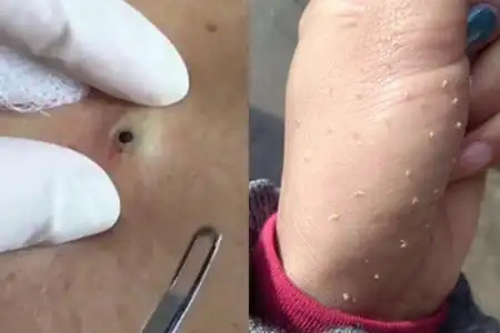 【图】大黑头挤出来图片太恶心 密集恐惧症者慎入