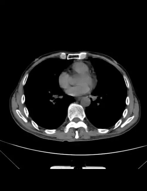 胸部ct平扫图片金典