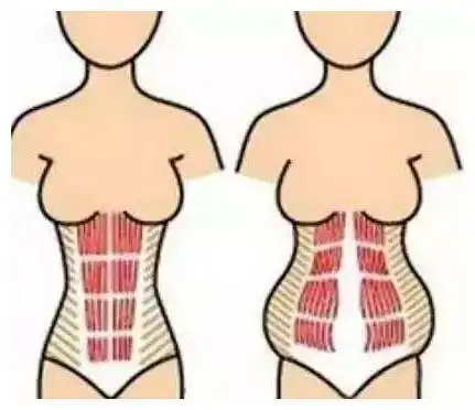 双胞胎妈妈晒生娃前后肚子对比照:生孩子,比我们想的更"伤身"