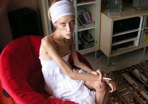 世界最瘦模特不幸身亡 令人深思 综合图片--创意图库 #采集大赛