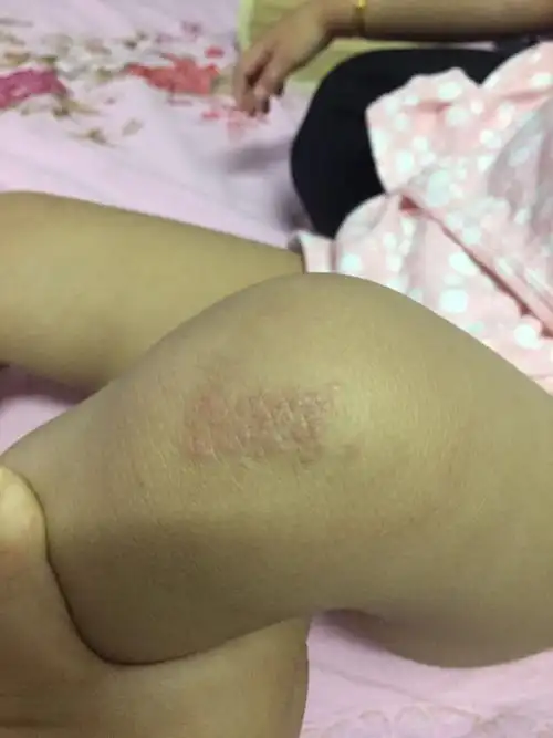 女儿膝盖皮肤有疹子
