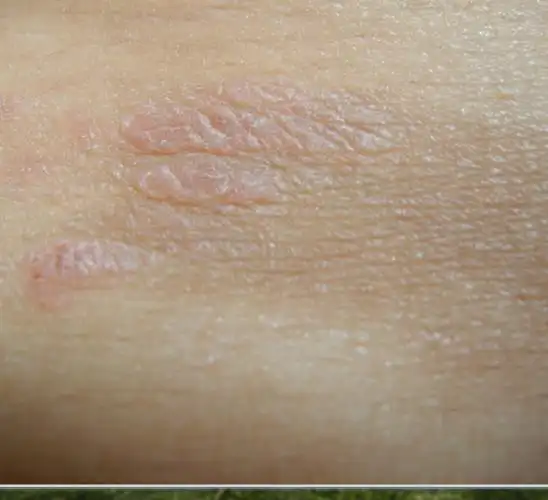 小腹上突然一块一块的灰色的,干,然后痒,就成这样的了,这是什么啊