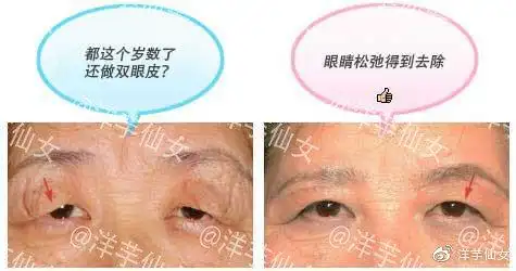 工匠的技术眼睑下垂的治疗