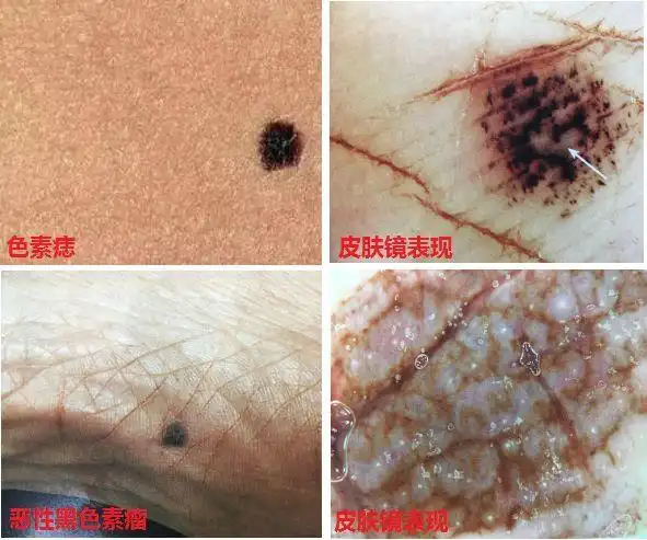 前沿一镜在手无所遁形市一医院皮肤科新引进皮肤镜神器到底有多神奇