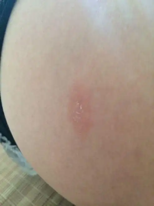 体癣有什么特点呢