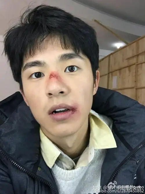 求刘昊然受伤图?