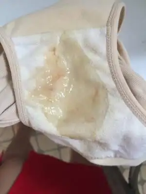 今早起床发现内裤上有像鼻涕一样的东西,感觉还有红血丝,今天都39 6了