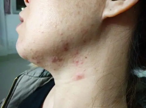 我的脖子生这些红孢已经3,4个月了,看了医生,说是毛囊堵塞,抹了药一