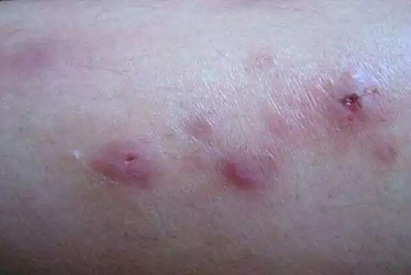 男性一期梅毒图片49