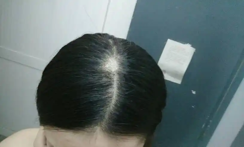 头发在理发店做完软化之后掉了一大片,我可以要求他赔偿多少?