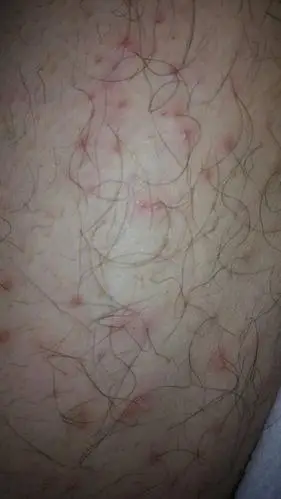 冬天腿上起了好多小红疙瘩 而且都是长在腿毛上的.