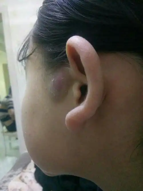 我妹妹耳朵旁边张了个包,求医生或专家看看这是什么.
