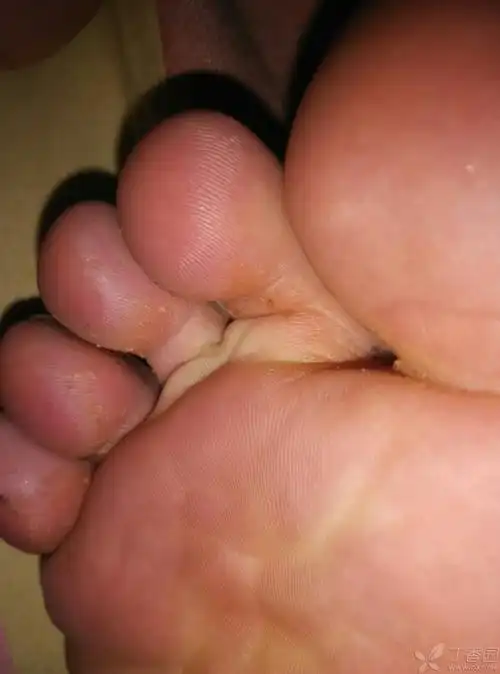 各位老师帮看一下阴囊干燥结痂