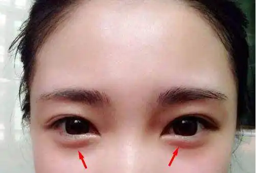 卧蚕饱满,隆起 面相学上说:三阳卧蚕如横—指位冠人臣作夔契.