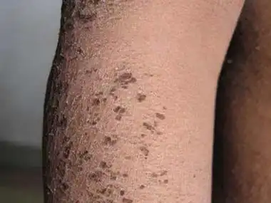 北京治鱼鳞病哪个医院好