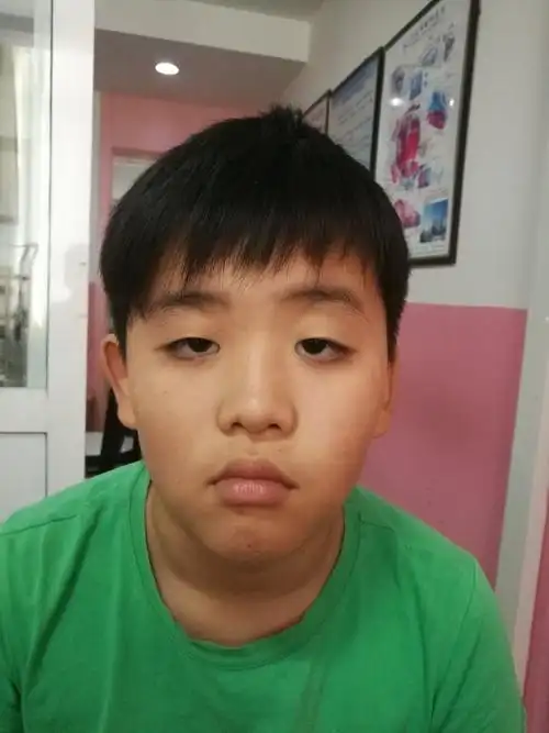 儿童上睑下垂
