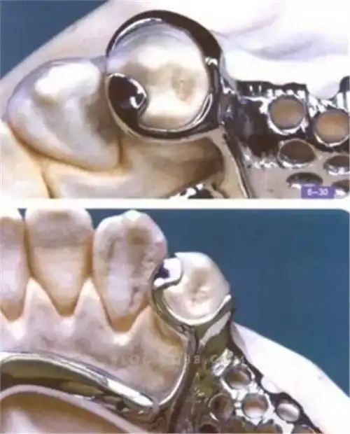 游离端缺失末端基牙十大推荐铸造卡环