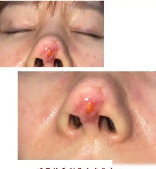 交友需谨慎演员高溜经朋友介绍整容后鼻子坏死毁容失去工作