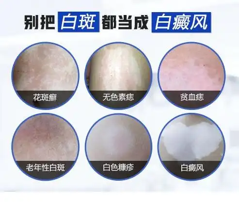 怎么辨别白斑是不是白癜风!皮肤科医生给你总结好了!