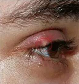 严重些,主要是因为化脓性细一般来说,外麦粒肿的临床症状来得化脓炎症