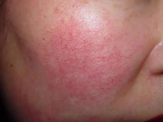 脸蛋上的红血丝是怎么形成的脸上的红血丝是怎么造成的