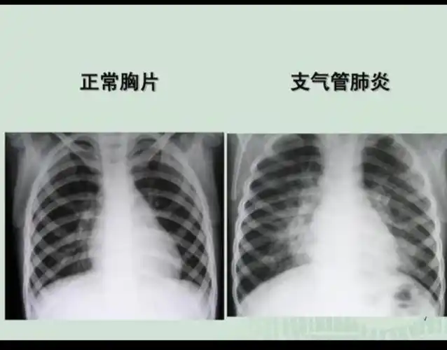 我国小儿支气管肺炎主要为细菌感染,以肺炎链