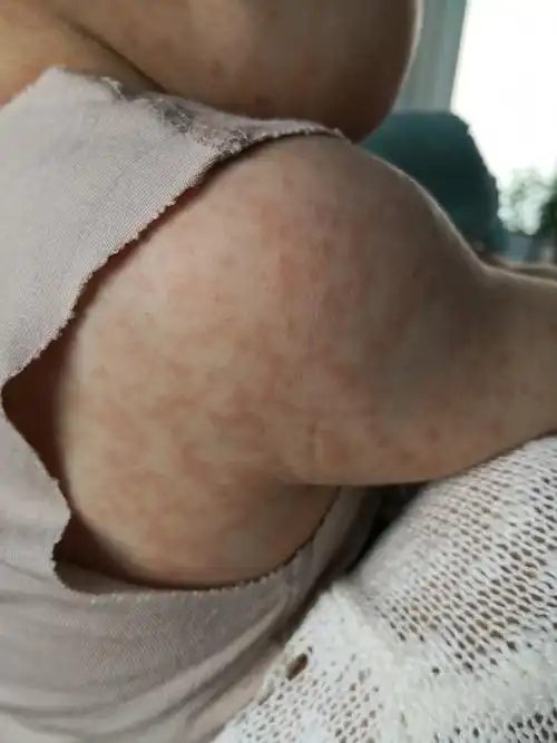 儿童过敏的常见病因分析