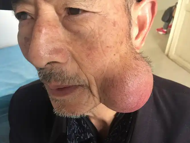 面部肿物三十年