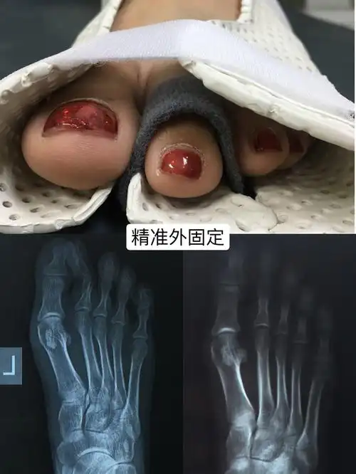 同济医院康复医学科假肢矫形中心的"暑期作业"