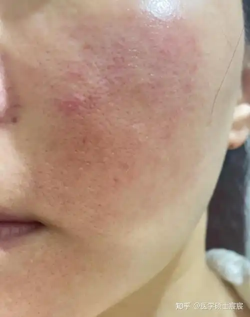 当你皮肤敏感,脸颊泛红干痒,外油内干,看完这篇彻底解决你的皮肤