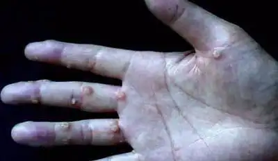 扁平疣长什么样子扁平疣图片