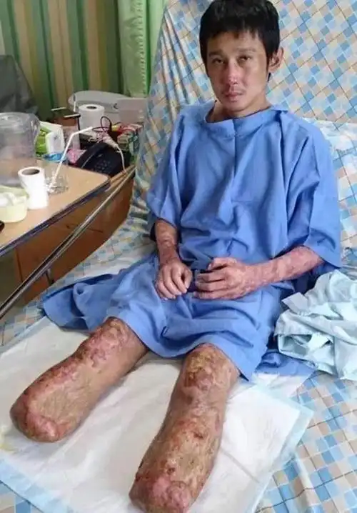 男子吃生猪肉末后感染,为保命不得不双腿截肢!