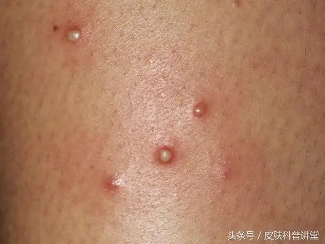 皮肤科普讲堂一日一病例,010 毛囊炎