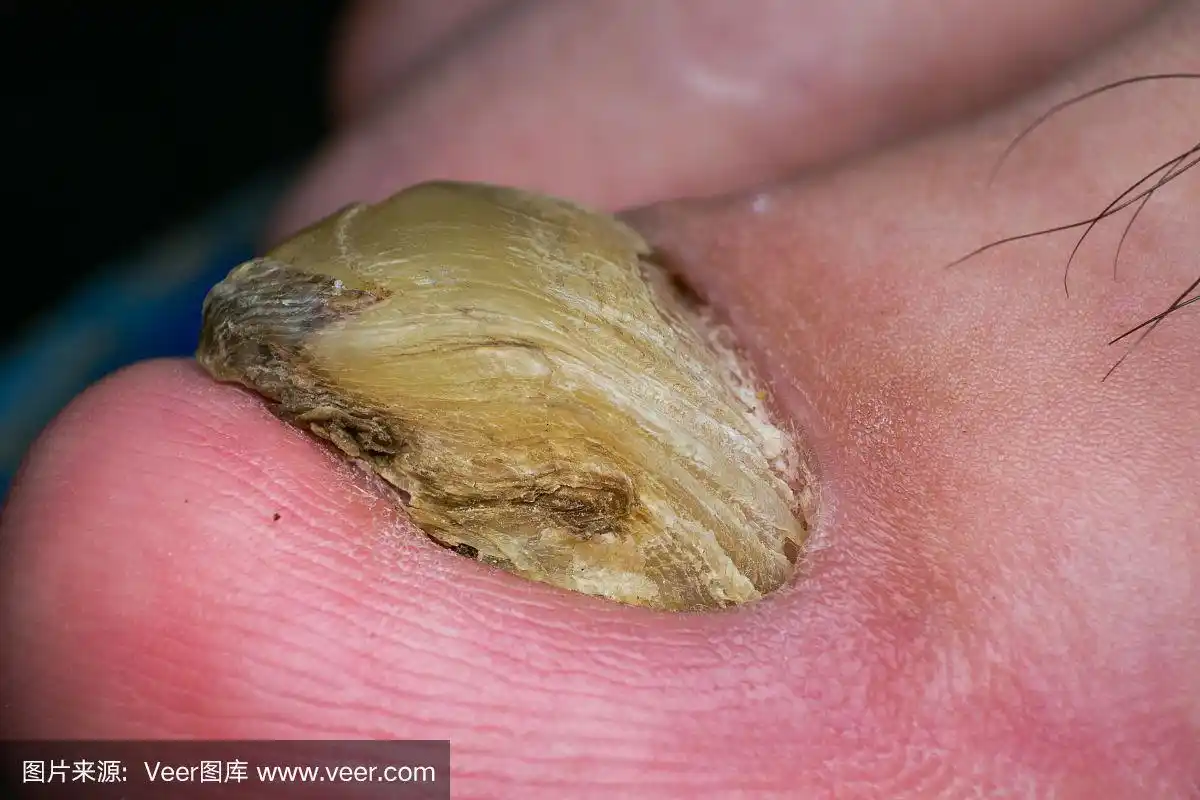 人脚趾甲真菌感染宏
